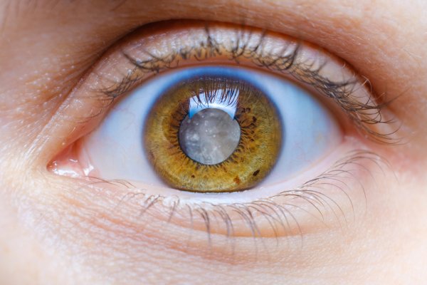 Close-up of human eye showing cataract with cloudy, opaque lens causing vision impairment before cataract surgery treatment