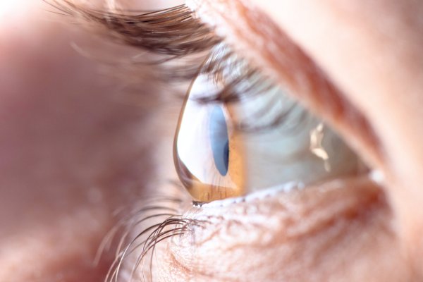 Close-up of an eye with visible corneal bulging, showing advanced keratoconus symptoms